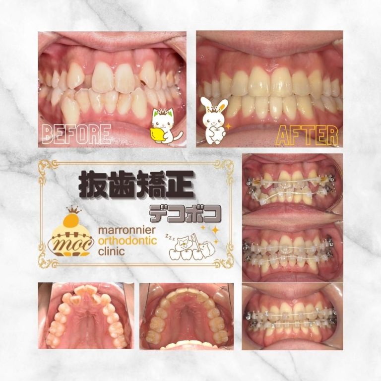 抜歯矯正①